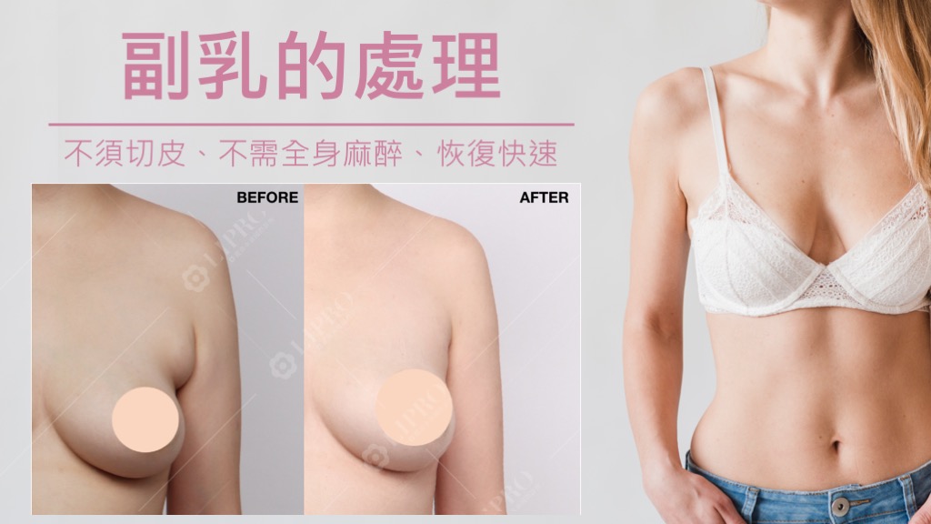 副乳手術費用