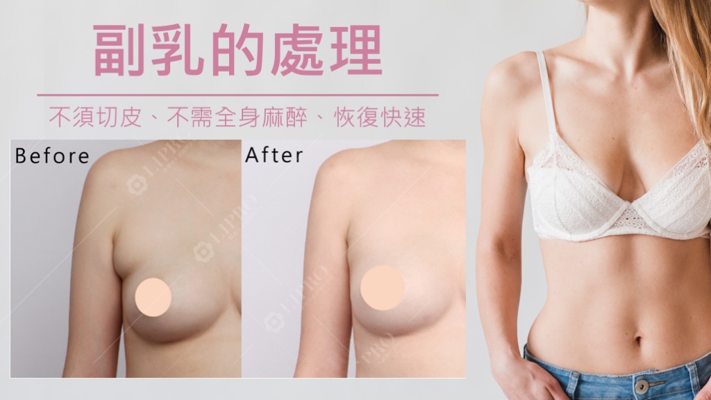 副乳手術台北