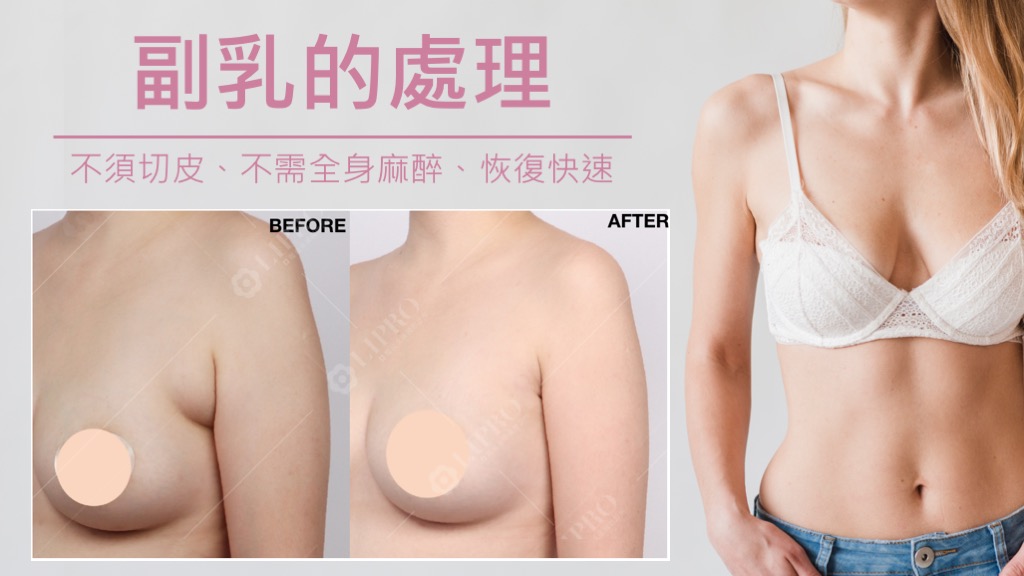 副乳手術台北