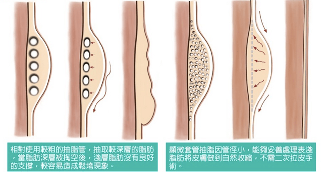 大腿抽脂顯微套管抽脂