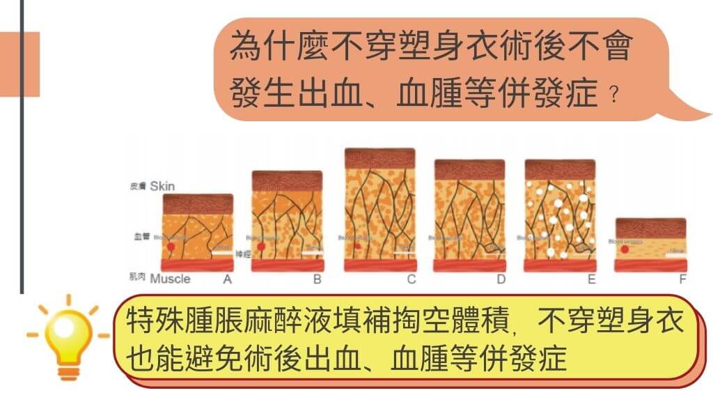 什麼是顯微套管抽脂、抽脂術後