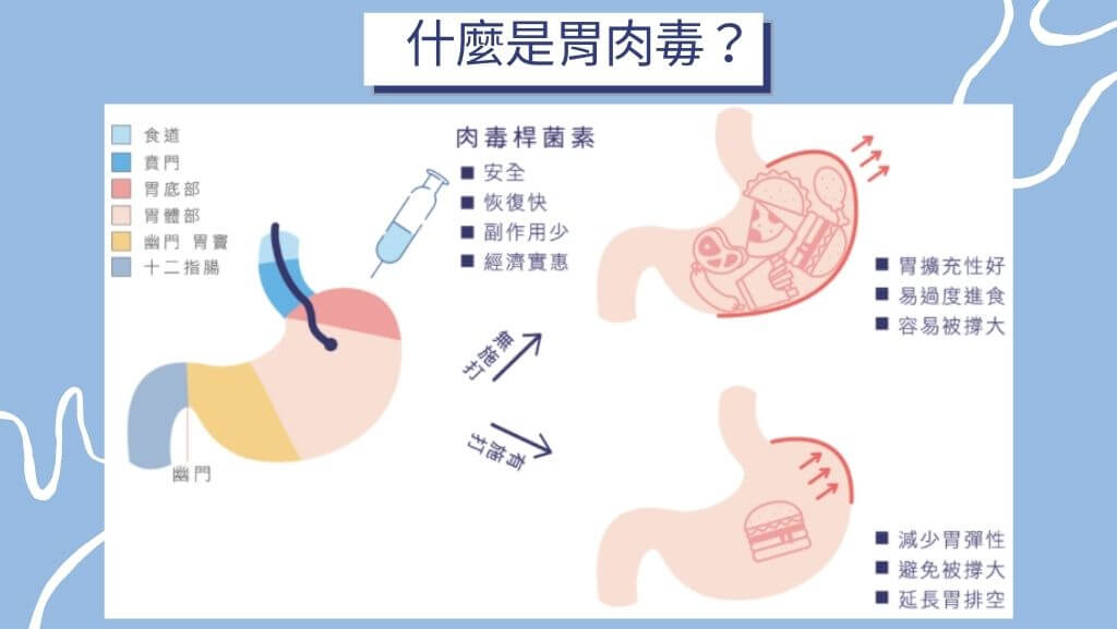 胃肉毒、縮胃針、胃肉毒價格