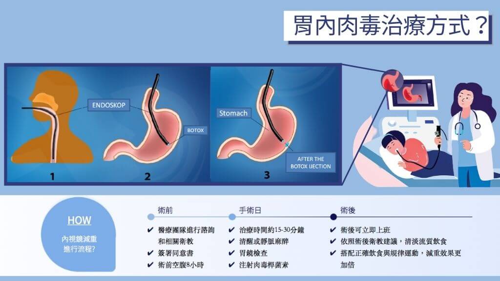 胃肉毒、縮胃針、胃肉毒價格