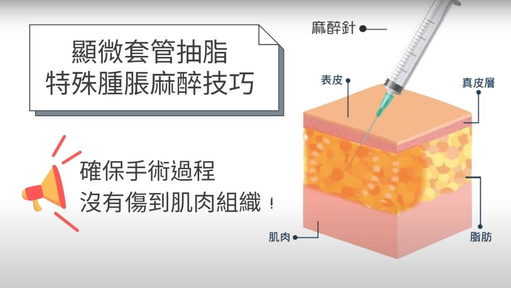 抽脂塑身衣、抽脂術後