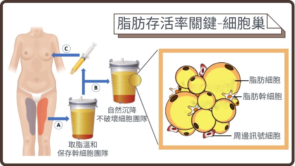 自體脂肪隆乳、豐胸