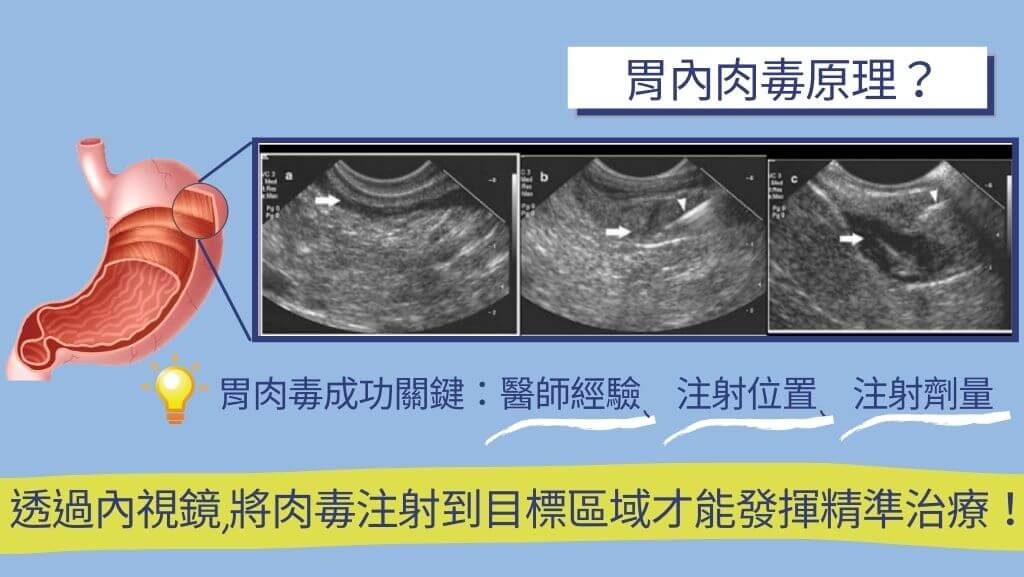 胃肉毒原理、縮胃針、胃肉毒價格