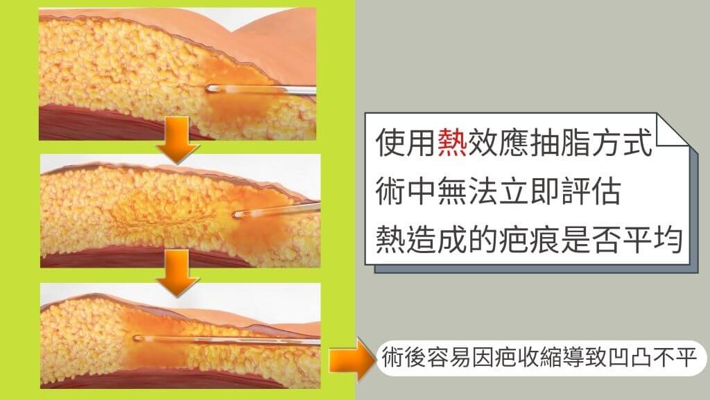 什麼是顯微套管抽脂