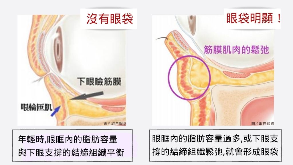 淚溝成因、淚溝處理