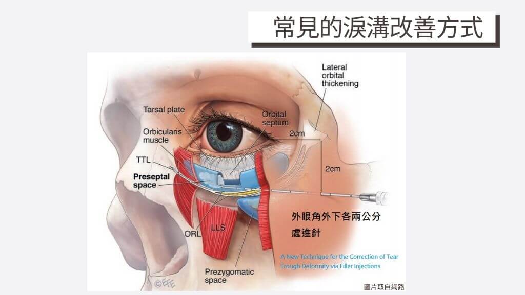 淚溝成因、眼袋成因