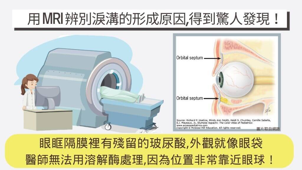 淚溝成因、眼袋成因