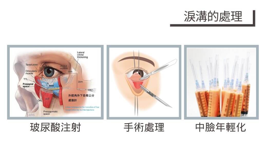 淚溝處理、淚溝填充、淚溝改善