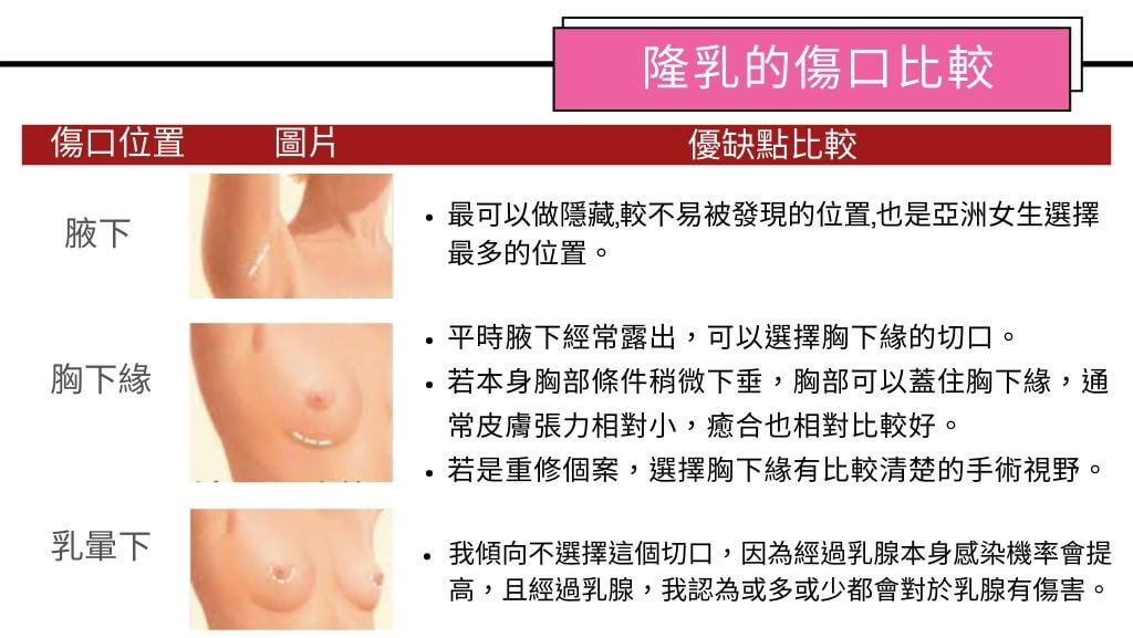 隆乳手術費用、假體隆乳