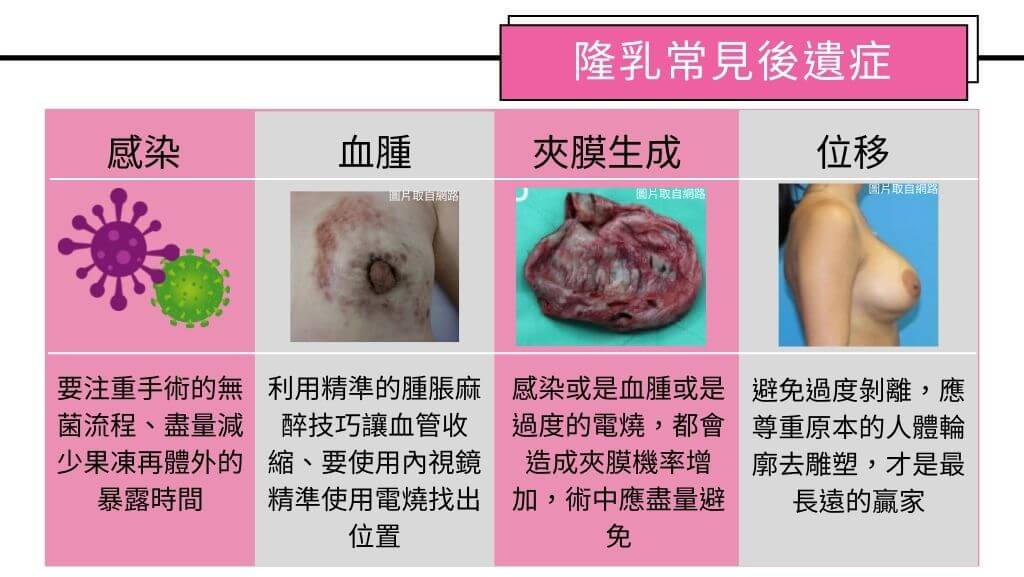 隆乳手術、假體隆乳後遺症、隆乳手術失敗、隆乳費用