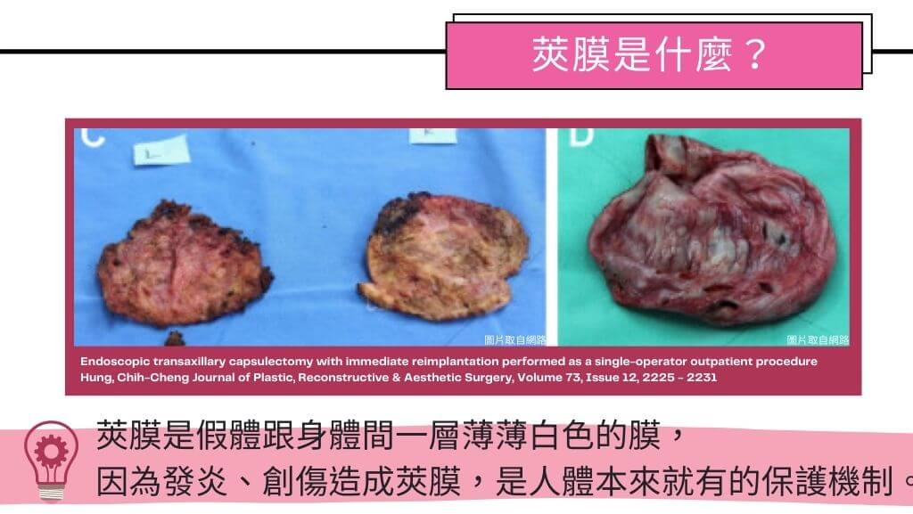 隆乳手術、假體隆乳後遺症、隆乳手術失敗、隆乳費用