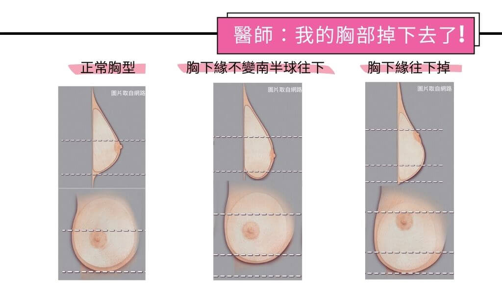 隆乳手術、假體隆乳後遺症、隆乳手術失敗、隆乳費用