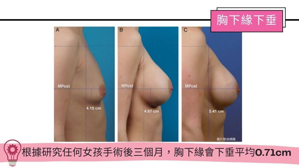 隆乳手術、假體隆乳後遺症、隆乳手術失敗、隆乳費用