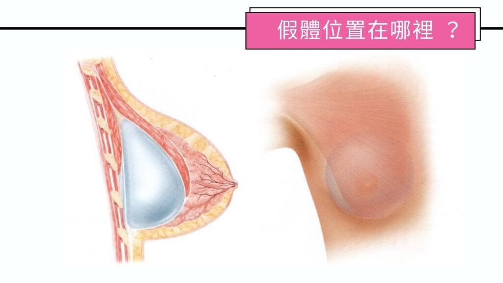 隆乳手術費用、假體隆乳