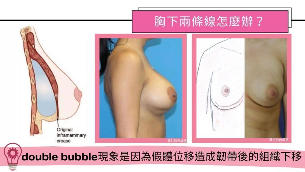 隆乳手術、假體隆乳後遺症、隆乳手術失敗、隆乳費用