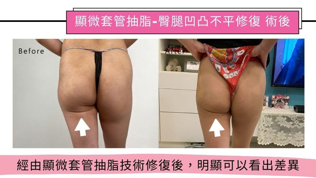 隆乳手術、假體隆乳後遺症、隆乳手術失敗、隆乳費用