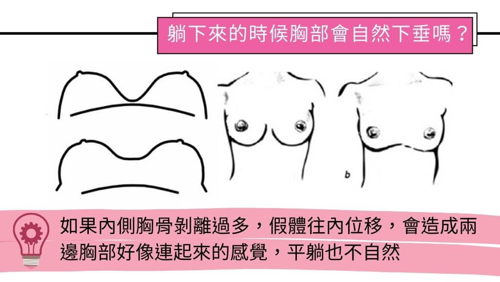 隆乳手術、假體隆乳後遺症、隆乳手術失敗、隆乳費用