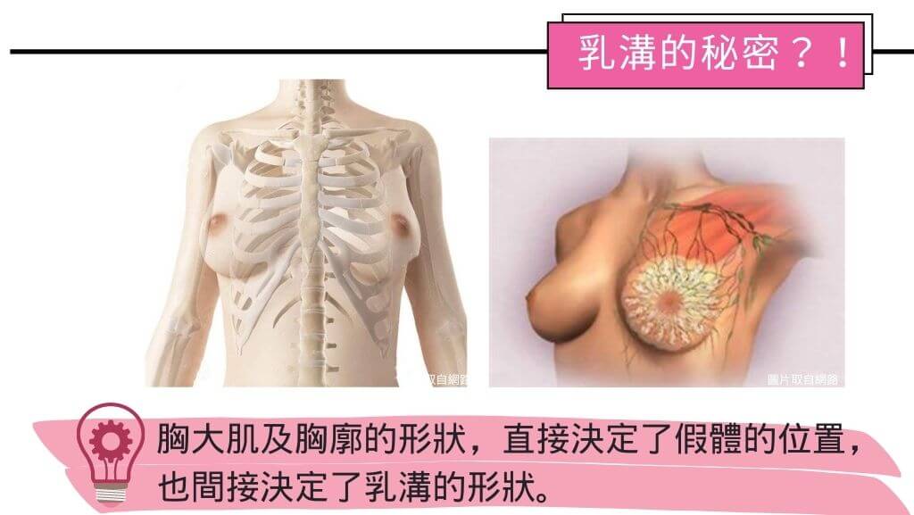 隆乳手術費用、假體隆乳