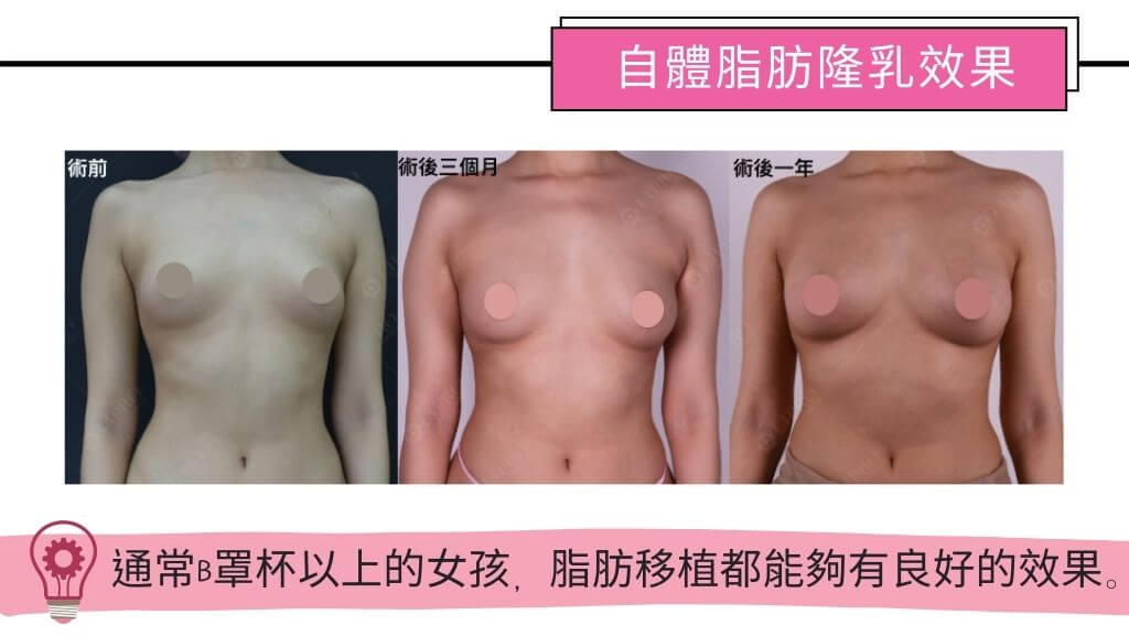 隆乳手術費用、假體隆乳