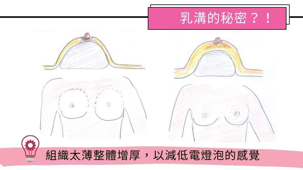 隆乳手術費用、假體隆乳