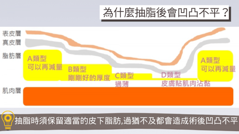 抽脂失敗、抽脂後凹凸不平、抽脂失敗後遺症、腹部抽脂失敗、臀腿抽脂失敗、腹部抽脂失敗、抽脂手術風險