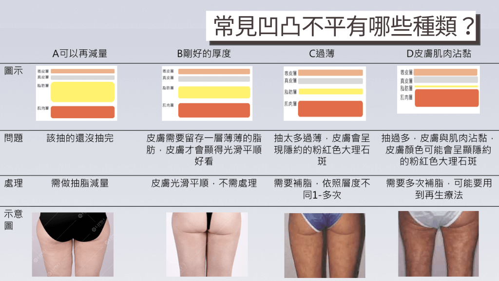 抽脂失敗、抽脂後凹凸不平、抽脂失敗後遺症、腹部抽脂失敗、臀腿抽脂失敗、腹部抽脂失敗、抽脂手術風險