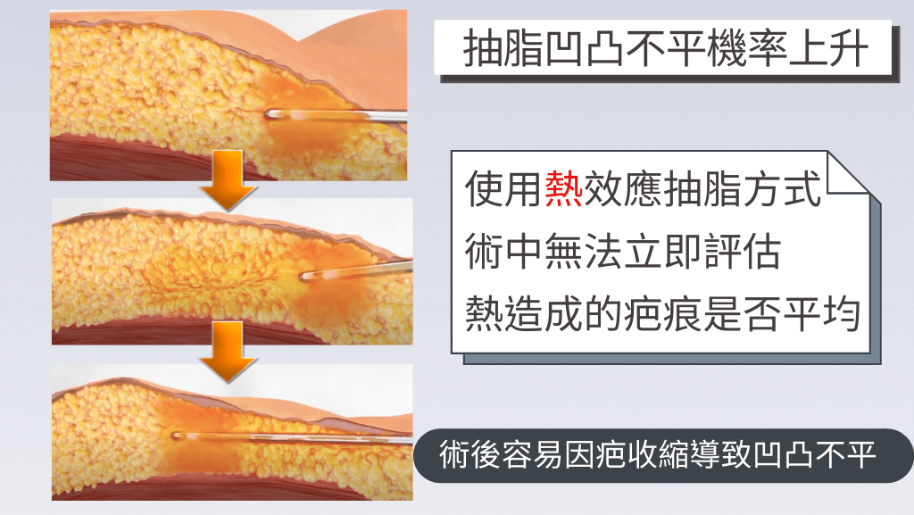 抽脂失敗、抽脂後凹凸不平、抽脂失敗後遺症、腹部抽脂失敗、臀腿抽脂失敗、腹部抽脂失敗、抽脂手術風險