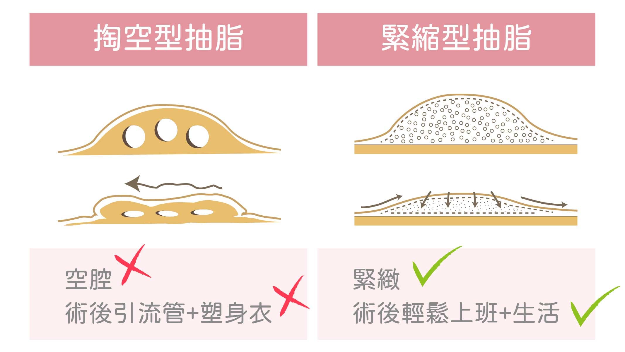 抽脂類型