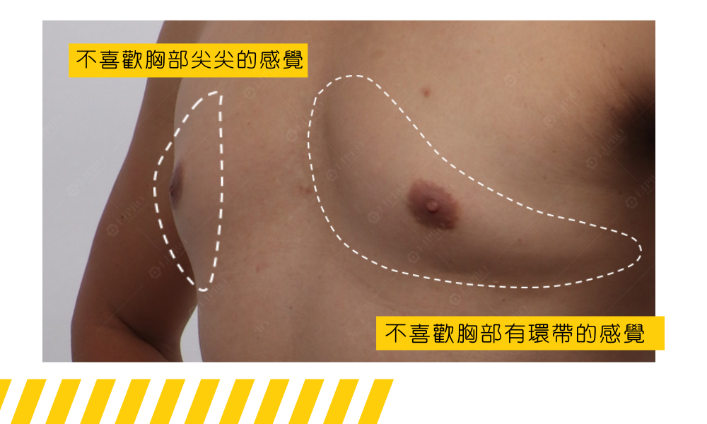 健身型男乳案例術前照