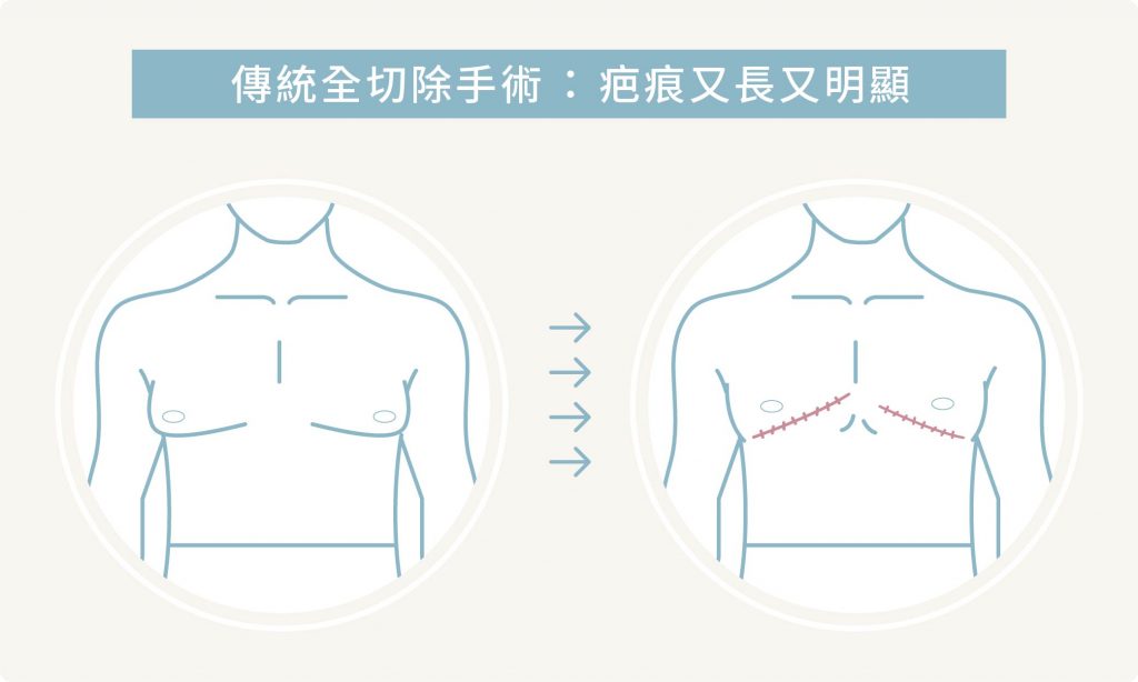 傳統手術缺點