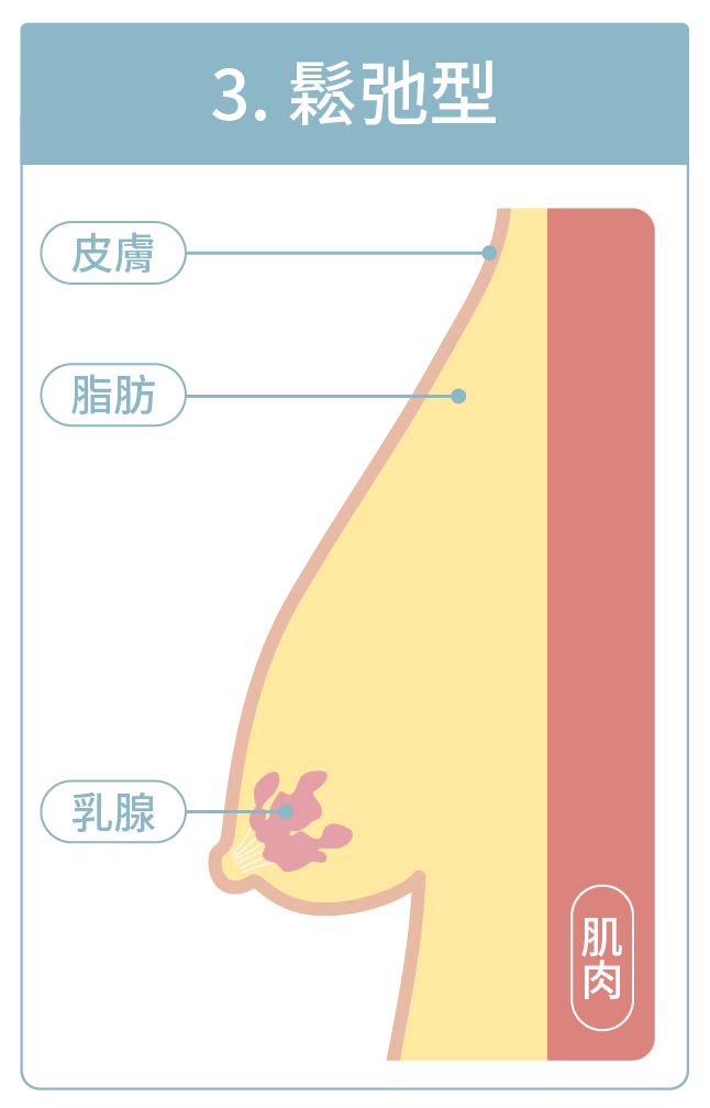 男乳類型之鬆弛型