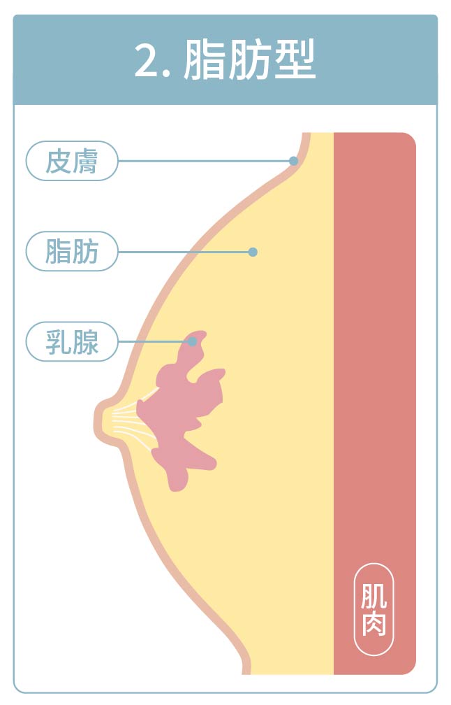 男乳類型之脂肪型