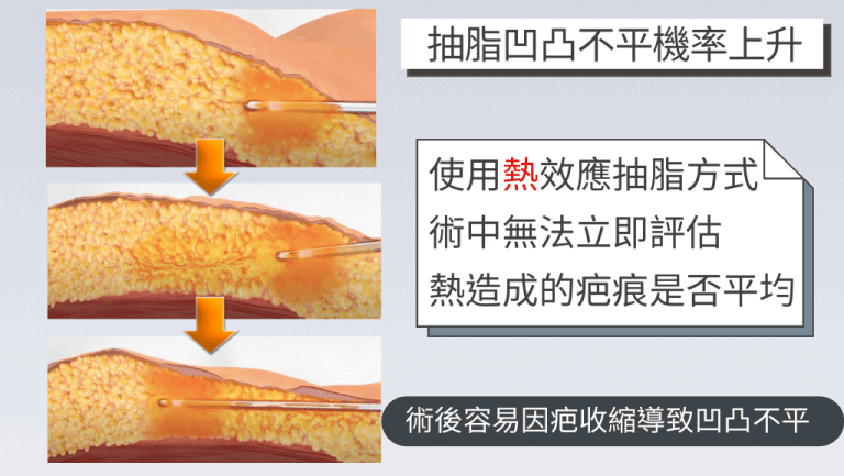 熱效應的抽脂方是術中難以評估疤痕是否平均，術後較容易產生凹凸不平的狀況