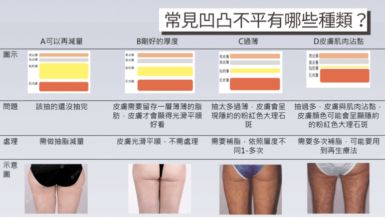 圖片和案例分享常見的抽脂失敗狀況，歸納症狀原因和修復重點