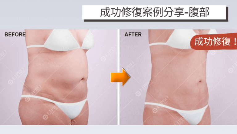 腹部抽脂後出現明顯凹陷痕跡是常見的抽脂失敗情況之一