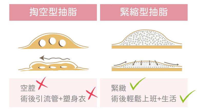 圖示解說不同的抽脂手術類型成效，顯微套管抽脂手術屬於緊縮型抽脂，術後不必穿著塑身衣