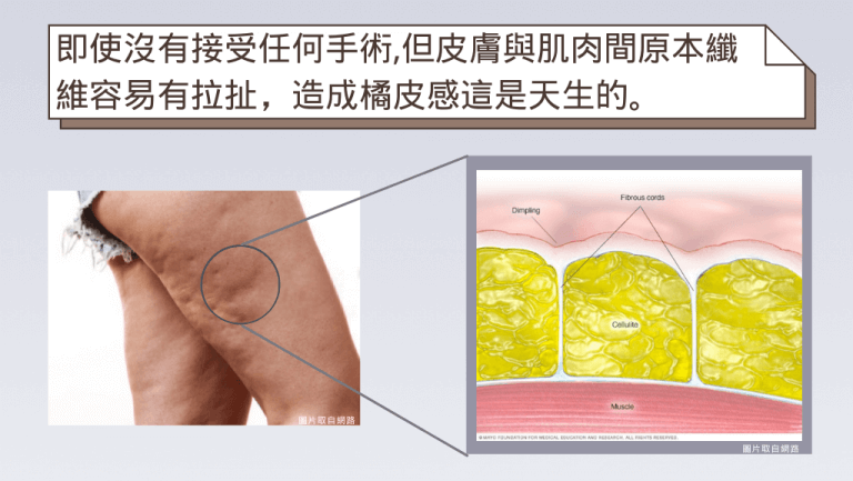 抽脂可改善凹陷拉扯感，但若變胖還是會有橘皮感的產生喔