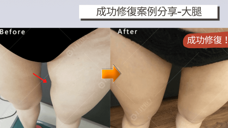 顯微套管技術精鑄填補因抽脂失敗產生的大腿內側凹陷處