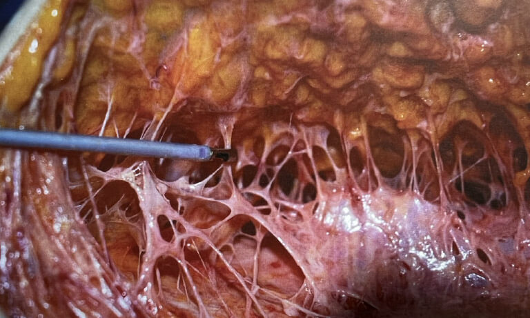 Fibro-Septal Network (FSN)